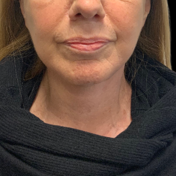 necklift-after